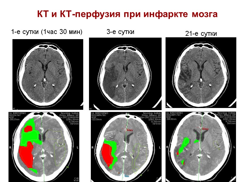 КТ и КТ-перфузия при инфаркте мозга 1-е сутки (1час 30 мин) 3-е сутки 21-е